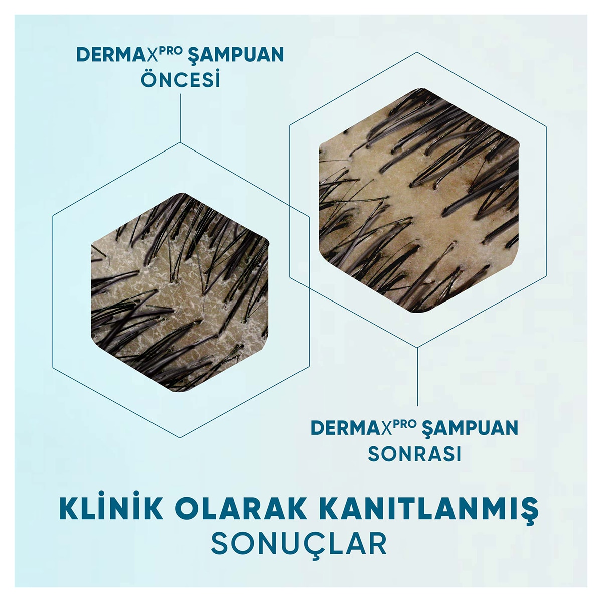  HEAD&SHOULDERS HEAD&SHOULDERS Head&Shoulders DermaXPRO Onarıcı Nemlendirme Kepek Karşıtı Şampuan Hindistan Cevizi Yağı ve Seramid 300 ml  1 of 5 