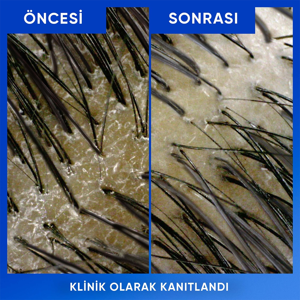 HEAD&SHOULDERS HEAD&SHOULDERS Head&Shoulders Arındırma ve Parlaklık Kepek Karşıtı Şampuan Elma Sirkesi 800 ml 1 of 5